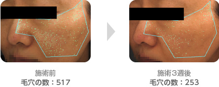 脂漏性角化症と毛孔拡大治療例