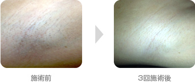 脱毛治療例