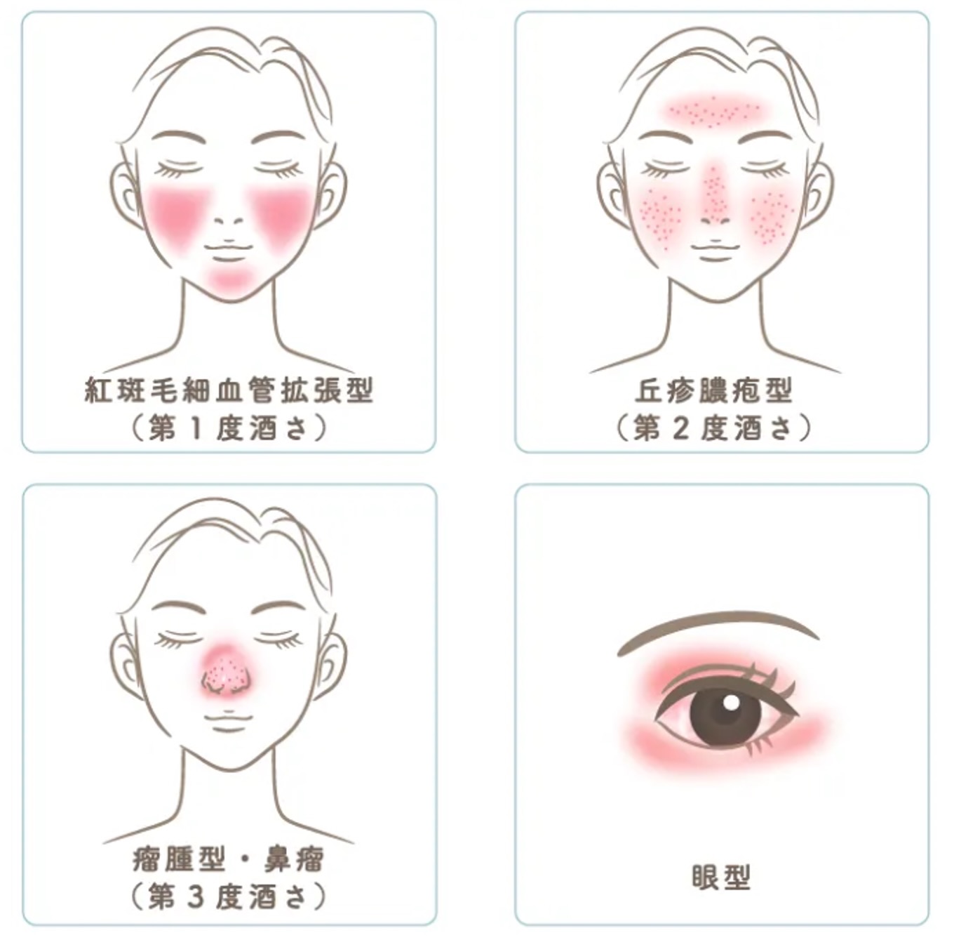 酒さ・赤ら顔のイラスト