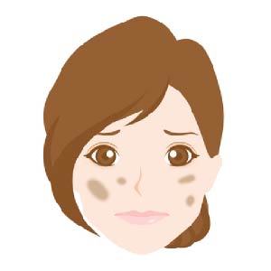 しみ、そばかすの治療に有効なレーザー装置