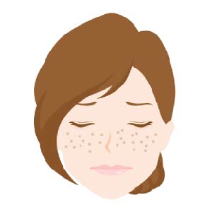 しみ、そばかすの治療に有効なレーザー装置