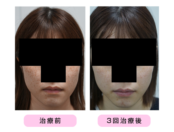 女性のそばかすの治療例